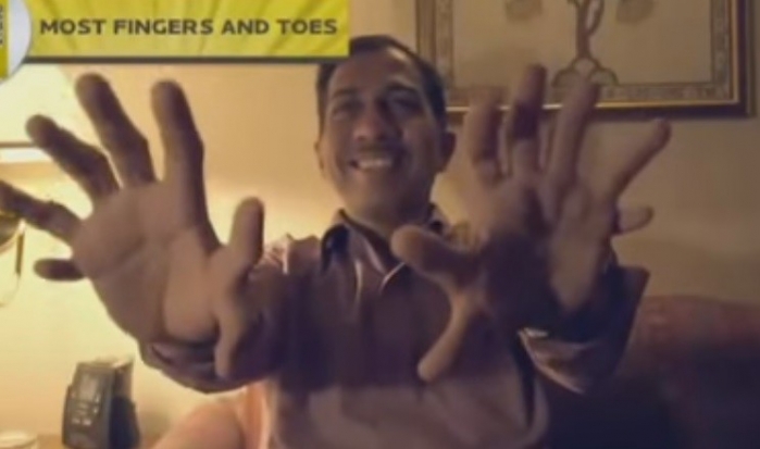 بالفيديو.. رجل يملك 28 إصبعاً ويعتبر نفسه 