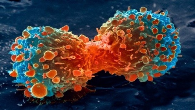 الصين.. ابتكار جهاز لتدمير الخلايا السرطانية