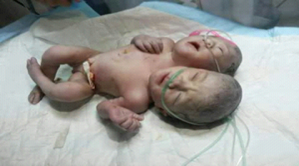 ولادة طفل برأسين وجسم واحد في مدينة غزة