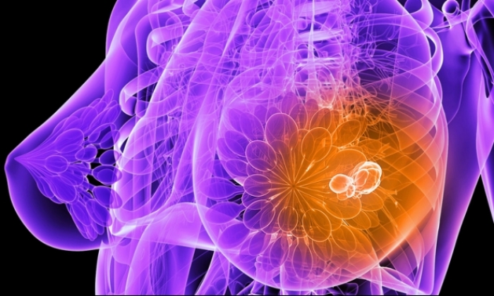اكتشاف خارطة الجينات المسببة لسرطان الثدي