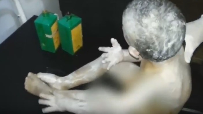 طفل سوري يرتجف من حروق قذائف 