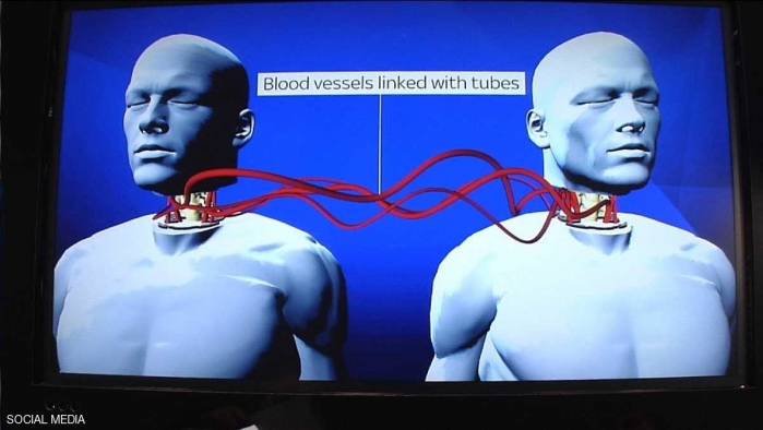 الحلم أصبح حقيقة.. علماءٌ ينجحون بزراعة رأس جثة بشرية