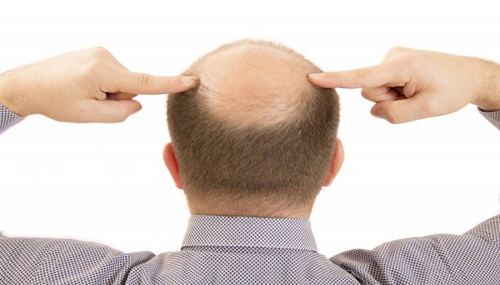 كيف يؤثر التوتر والإجهاد على صحة الشعر؟
