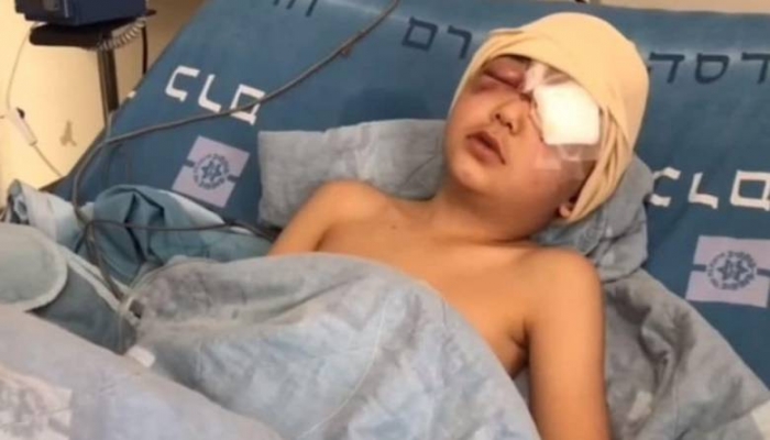 استئصال عين الطفل مالك عيسى الذي أصيب برصاص الاحتلال في العيسوية
