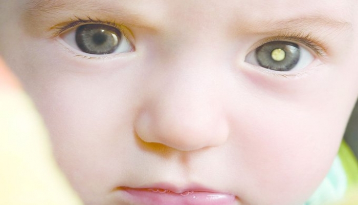 طريقة كشف الإصابة بسرطان العين عند الأطفال عن طريق الموبايل