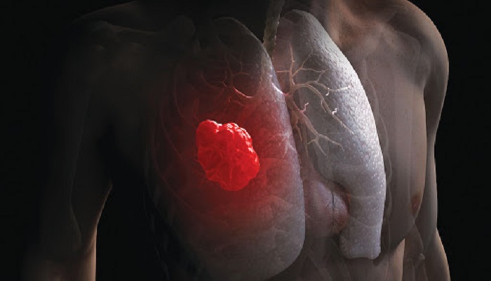 ثلاثة أدوية شائعة تمنع الإصابة بسرطان الرئة
