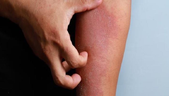 الجلد الجاف والمثير للحكة يمكن أن يكون علامة على مرض مزمن