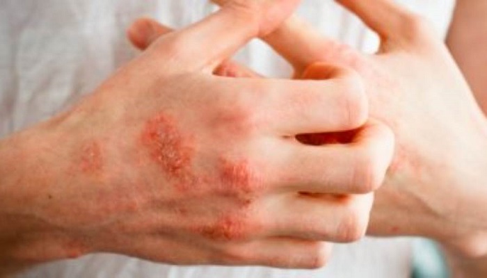 دراسة بريطانية تكتشف ارتباط أمراض الجلد بمشكلات الصحة العقلية
