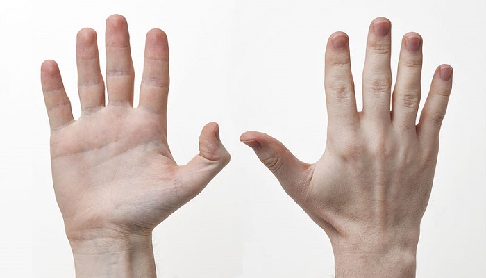 هل يوجد ارتباط بين أطوال أصابع اليد وشدة مرض 