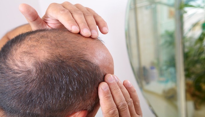 طبيب روسي يحدد العقارات المسببة لتساقط الشعر
