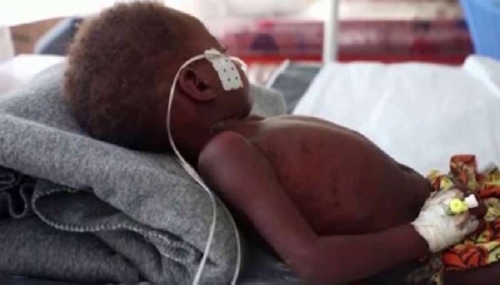 وفاة أكثر من 150 طفلا بالحصبة في زيمبابوي في أسبوعين
