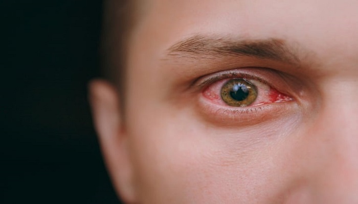 أمراض العيون تكشف