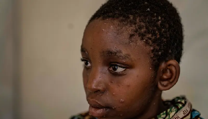 إصابات جديدة بجدري