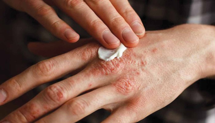 أمراض جلدية تتفاقم