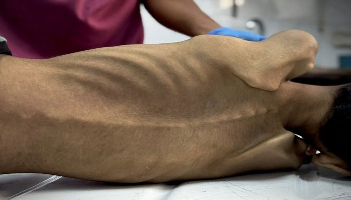 وفاة طفلين شمال وجنوب قطاع غزة بسبب سوء التغذية والمجاعة