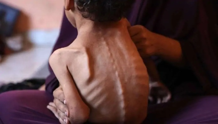 5 وفيات بينهم طفل نتيجة المجاعة وسوء التغذية خلال الساعات الـ24 الماضية
