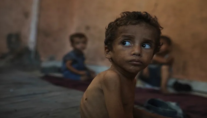 بريطانيا: الاحتلال مسؤول عن مجاعة غزة ونستقبل مزيدا من الأطفال للعلاج